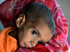 malnutrition