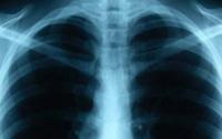 Tuberculosis