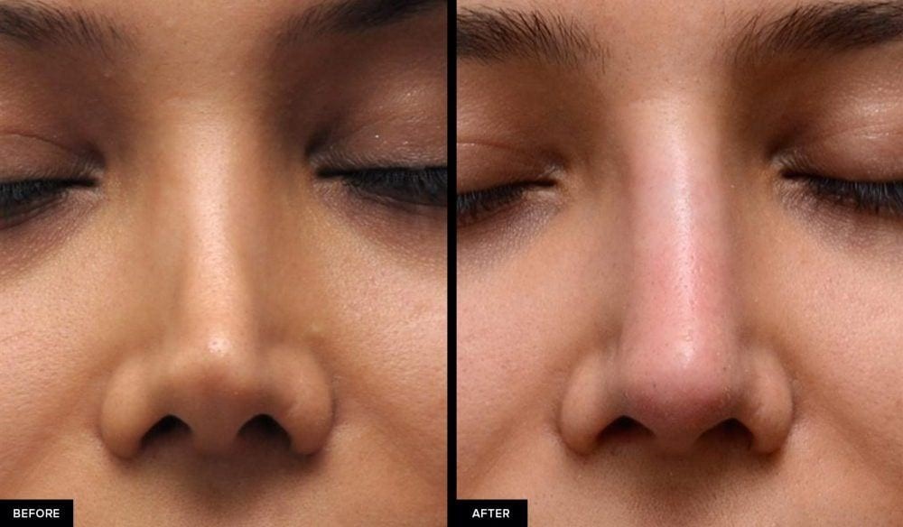 before after revision rhinoplasty