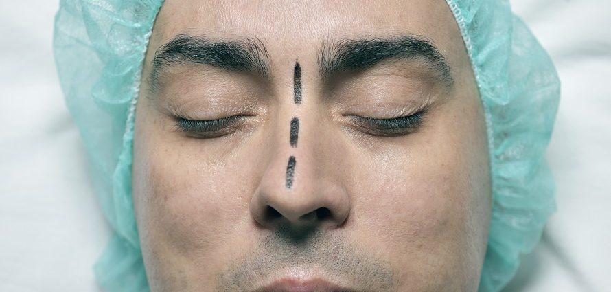 patience ready for revision rhinoplasty